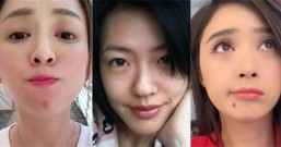 正确洗脸,能消除痘痘!让小s也推荐的祛痘痘洗脸5法