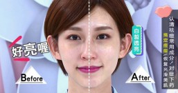 万恶的痘痘!认清常用祛痘成分对症下药 去除纠缠不清的痘痘