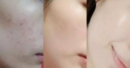妙龄女满脸青春痘久治不愈 低剂量口服A酸战痘成功