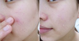 冒痘痘、粉刺多、毛孔大?美肤堂揭秘4种治疗有效祛痘