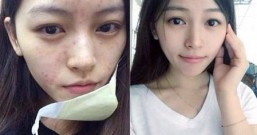 小心粉刺变痘痘 3招抗痘保养术