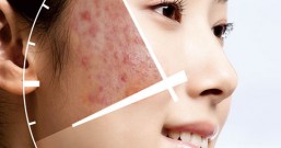 为什么会长痘痘,长痘痘是什么原因?青春痘的产生有许多复杂的因素