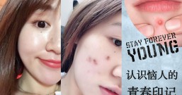 认识恼人的青春印记,痘痘问题和日常处理方法