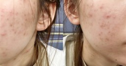 为什么祛痘洗面奶祛痘药膏都用过,痘痘还是反复不停长?学生党亲测4步祛痘法,痘痘真的消失了!