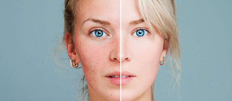 rosacea.jpg